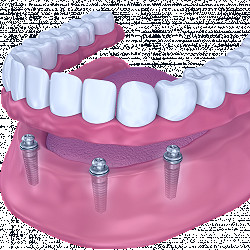 Implant-Supported Dentures - Virginia Beach, VA - Dr. Scott Parr